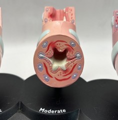 Flovent Asthma Trachea Bronchus Anatomical Pathology Model Pharmadesign 1999