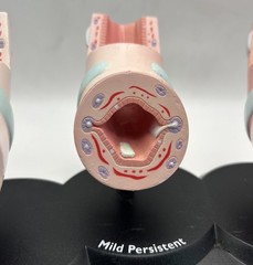 Flovent Asthma Trachea Bronchus Anatomical Pathology Model Pharmadesign 1999
