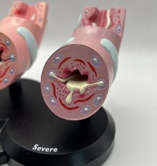 Flovent Asthma Trachea Bronchus Anatomical Pathology Model Pharmadesign 1999