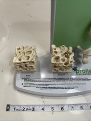 Prolia (Denosumab) Injection Pharmaceutical Model Advert For Doctors Office