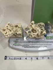 Prolia (Denosumab) Injection Pharmaceutical Model Advert For Doctors Office