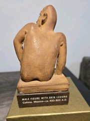 Vintage Pharmaceutical Advertising Figurine Valisone Cream Man With Skin Lesions